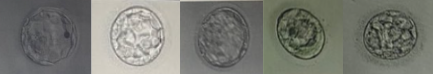 Ashley and Jason's embryos that were transferred during their IVF treatment at Care Fertility Sheffield.