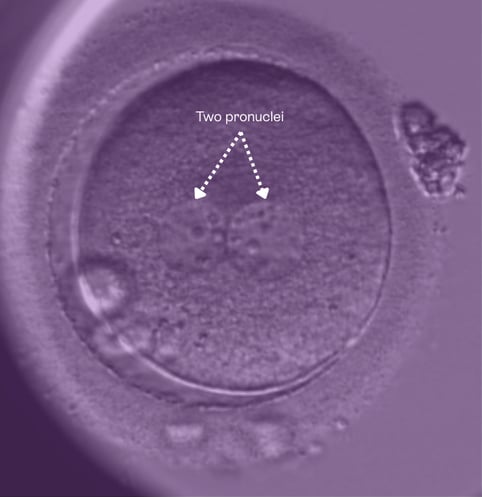 Embryo with 2PN